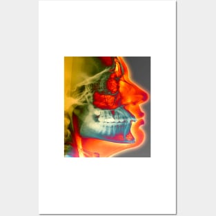 Orthodontic brace X-ray (M780/0342) Posters and Art